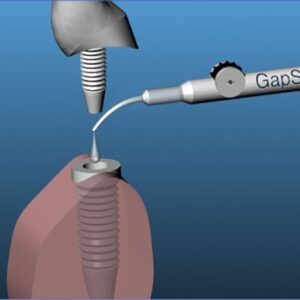 GAP SEAL sredstvo protiv implantitisa